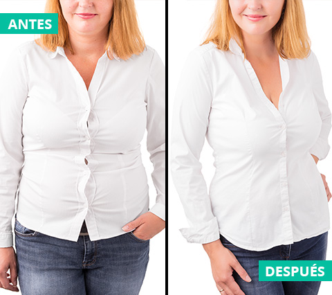 Comparacin de paciente antes y despus de liposuccin en Bogot