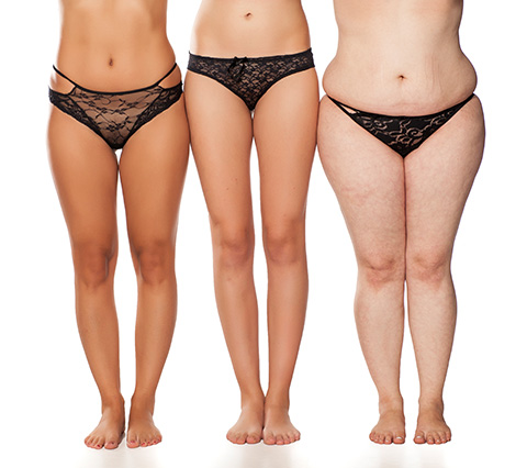 Mujeres que necesitan lipoescultura en Bogot