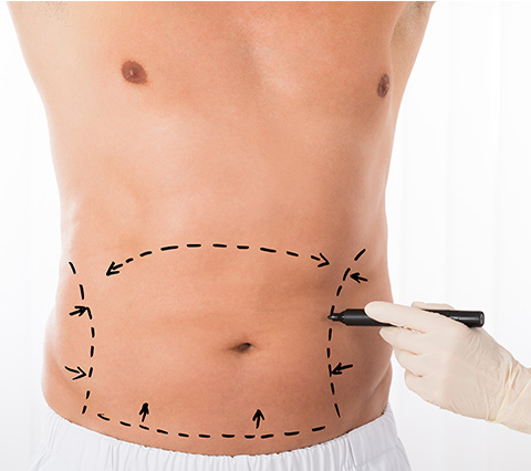 Elimine la grasa con la abdominoplastia en Bogotá Paciente que se prepara para abdominoplastia en Bogotá